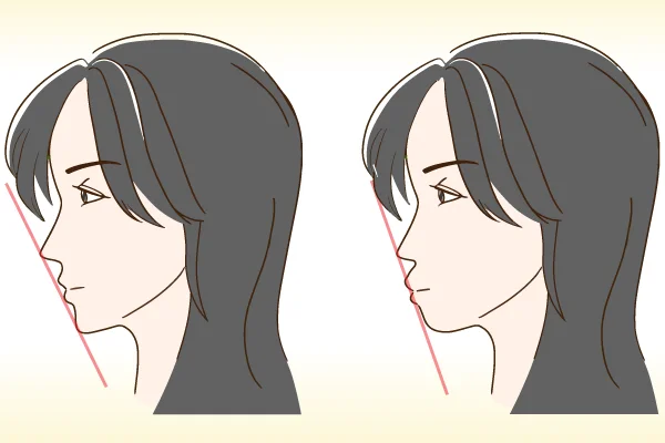 アデノイド顔貌の特徴